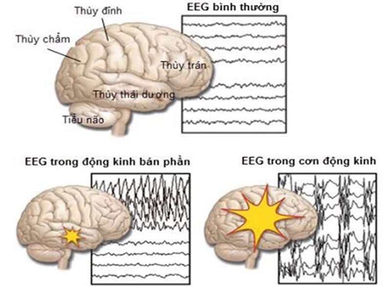 Dạng EEG (điện não đồ) của bệnh nhân động kinh